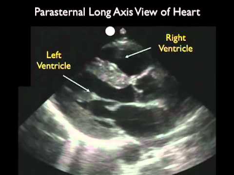 Permanent Pacemaker Pacemaker Surgery SA Heart